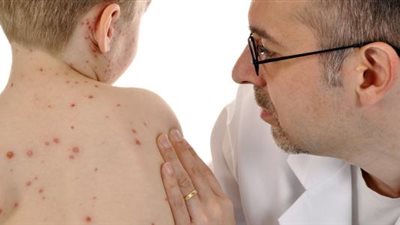 بعد إعلانه حالة طوارئ.. كيف تحمي نفسك من جدري القرود؟ 