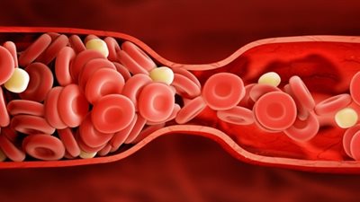 استشاري قلب يكشف السر وراء إصابة الشباب بالجلطات القلبية والسكتات الدماغية