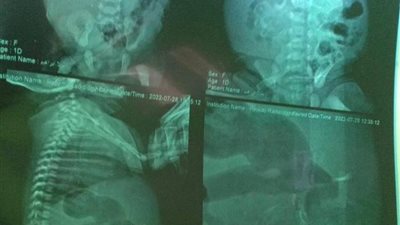 «رضيعة حامل».. حالة نادرة فى الدقهلية تُشعل السوشيال ميديا