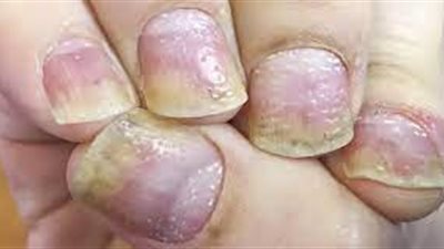 احذري من صدفية الأظافر.. إليك أعراض الإصابة وطرق الوقاية