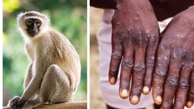 جدري القرود.. أنواع الفيروس وأعراضه وكيفية انتقال العدوى للإنسان