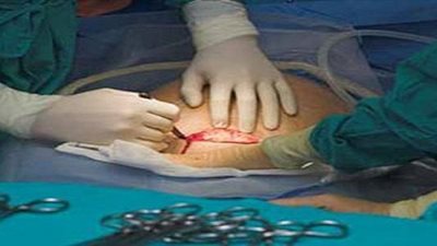 «الصحة» تشن حملة لمواجهة الولادة القيصرية دون مبرر (إنفوجراف)