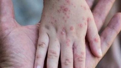 الصحة: 46 إصابة بفيروس جدري القرود في 6 دول عربية