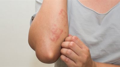 خاص| استشاري يوجه 4 نصائح لمرضى الحساسية الجلدية في فصل الخريف