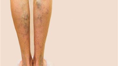 مشروبات شائعة تسبب الدوالي وانسداد الأوعية الدموية