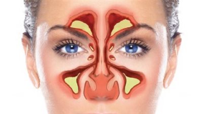 نصائح مهمة من الصحة لمرضى الجيوب الأنفية (إنفوجراف)