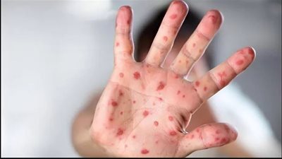 «الصحة العالمية» تحذر من جدري القرود وتعلنه حالة طوارئ دولية