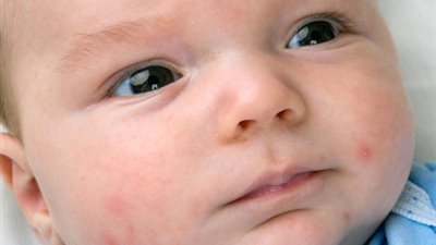 احذري.. 4 أخطاء تسبب ظهور البثور عند الطفل الرضيع