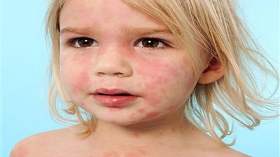  خطوات مهمة لإسعاف طفلك إذا تعرض لرد فعل تحسسي من الطعام