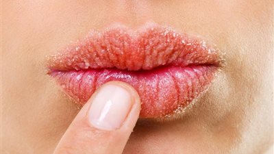 4 نصائح لحمايتك من تشقق الشفاه في الشتاء