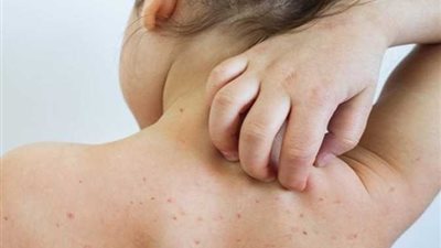 بعد إصابة مخالط.. تعرفي على أعراض جُدري القرود