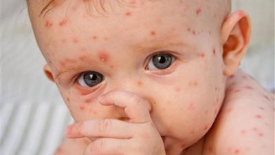 خلي بالك.. خطوات عليك اتباعها أثناء علاج جدري القرود