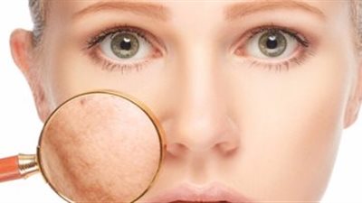 هل تُعانين من الإصابة بـ«الكلف»؟.. إليكِ أسبابه وطرق العلاج