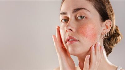 حساسية الارتكاريا، تعرفي على أعراضها وطرق علاجها 