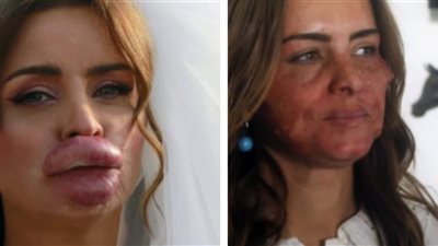 ما سبب ظهور الفنانة نور اللبنانية بتشوهات في الوجه؟!