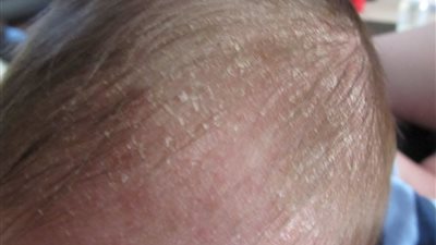 ماسبب فتحة رأس الرضع وموعد انغلاقها؟