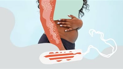 «تصيب امرأة من كل 100 ألف» هل متلازمة الصدمة التسممية مرض نسائي؟ 