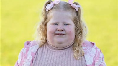 متلازمة «برادر ويلي»| طفلة لا تشبع أبدا وتصرف غريب من الأم لحمايتها (صور)