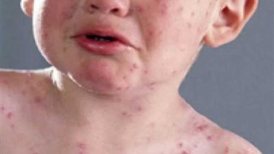 « لحماية طفلك» تعرفي على أسباب وطرق الوقاية من الحصبة