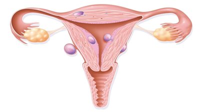 «بينها ارتفاع الضغط» أعراض ورم الرحم الحميد وخطورته