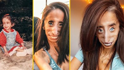 «واقعة نجاة» أمريكية مصابة بمتلازمة البروجيرويد تتجاوز الـ30 من عمرها