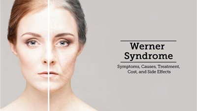 «متلازمة ويرنر» واحد من أمراض الشيخوخة المبكرة (البروجيرويد)