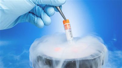 طبيب يكشف حالات اللجوء إلى تجميد البويضات 