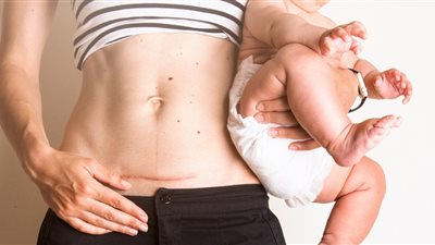 «الأسباب والعلاج» هل تعاني النساء من ألم الولادة القيصرية بعد سنوات؟ 