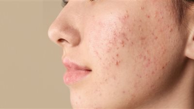 ما العلاقة بين القلق والإصابة بـ«حب الشباب»؟