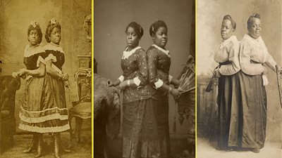 «الفتاة ذو الرأسين» توأم ملتصق عاشت إحداهما بعد وفاة شقيقتها نصف يوم 