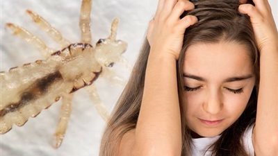 تفسير حلم ظهور القمل في المنام وعلاقته بعلامات السحر