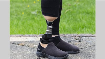 بشرى يحملها تفسير حلم قطع الرجل بالمنام في هذه الحالات