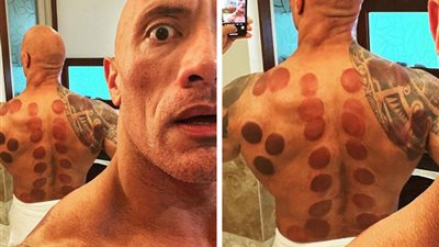 أبرزهم ذا روك وليدي جاجا| حكايات مشاهير العالم مع العلاج بالحجامة (صور)