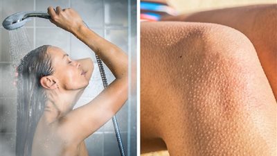 قبل الصيف| «6 ممنوعات» للتخلص من جلد الوزة عند النساء بدون جلسات علاجية