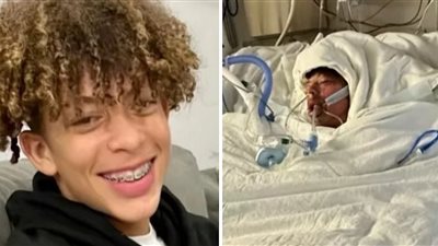 مراهق يحرق جسده بنسبة 75% بسبب تحدي جديد على تيك توك Tik Tok