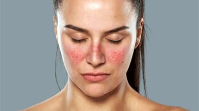 «في اليوم العالمي للتوعية بمرض الذئبة الحمراء» 7 أعراض وطرق العلاج