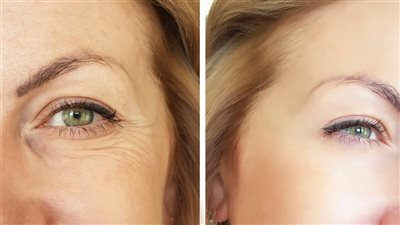 أسباب ظهور تجاعيد الوجه المبكرة وطرق الوقاية والعلاج 