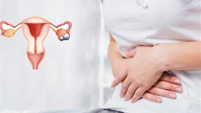 4 طرق طبيعية لعلاج تكيس المبايض أبرزها «الابتعاد عن القهوة»