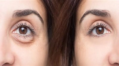 6 طرق منزلية فعالة للتخلص من انتفاخات تحت العين