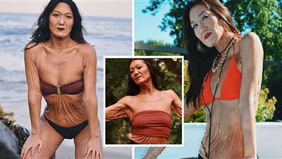 ثلاثينية تعاني من مرض نادر تبدو وكأنها ترتدي جلدها وتلقب «الشابة العجوز»