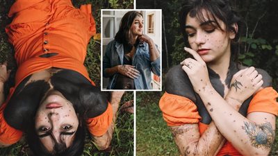 حكاية المرأة القردة| ولدت بوحمة سوداء تغطي 80% من جسدها وتنتظر مولودها الأول