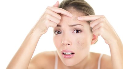 5 وصفات منزلية غير مكلفة لإزالة بثور الوجه قبل عيد الأضحى