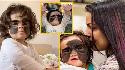 طفلة تولد بوجه الرجل الوطواط «باتمان» وتلقب بالفتاة الوحش