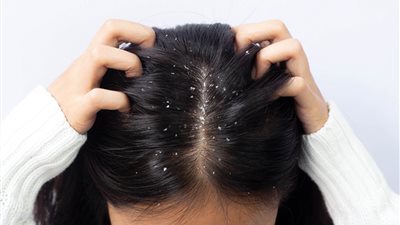 هاني الناظر ينصح بخلطة طبيعية للتخلص من قشرة الرأس