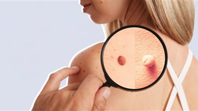 كيفية التخلص من الزوائد الجلدية دون الخضوع لجراحات الكي.. والفرق بين الحميدة والسرطانية