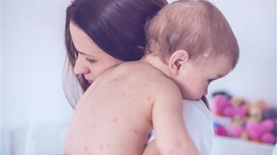  أسباب وعلاج الطفح الجلدي عند الاطفال بوصفات منزلية