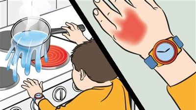 5 إسعافات أولية لمعالجة حروق الأطفال داخل المنزل «العسل والخردل»