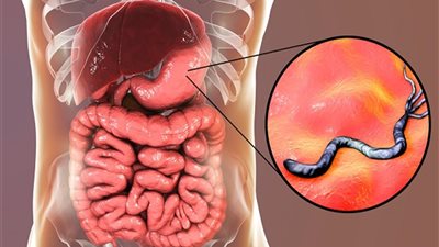 هل يمكن أن تعود جرثومة المعدة بعد الشفاء منها؟ حسام موافي يُجيب