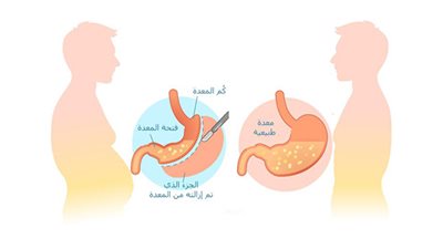 مخاطر عملية تكميم المعدة «هل تؤدي إلى الوفاة؟»