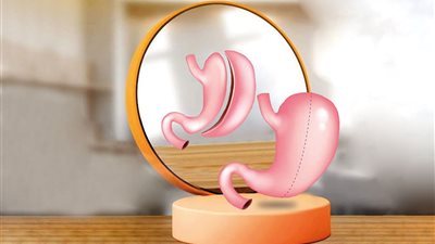 مميزات وعيوب عمليات تكميم المعدة والسن المناسب لإجرائها 